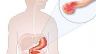 Les marges d’exérèse dans l’adénocarcinome pancréatique.