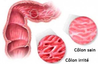 Quel régime à adopter pour le côlon irritable