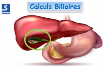 Calculs biliaires