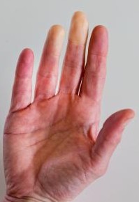 La maladie de Raynaud