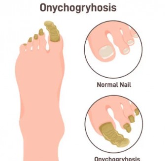 Onychogryphose 