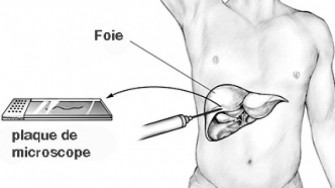 Dissémination tumorale le long du trajet de ponction biopsie hépatique : pas si rare ?