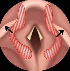 Laryngomalacie