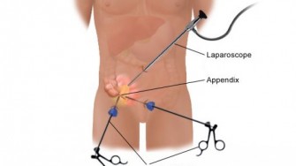 Appendicectomie par cœlioscopie, un bon choix même à long terme