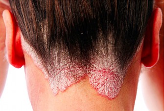 Psoriasis : plus dun million dAlgériens touchés et un traitement remboursé