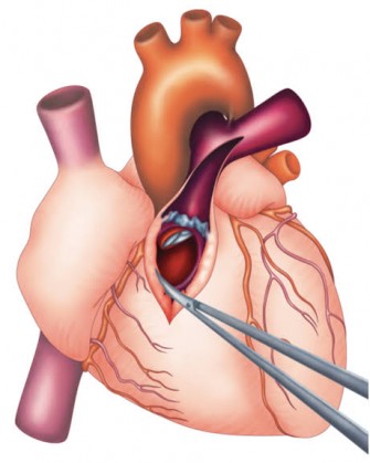 Tétralogie de Fallot