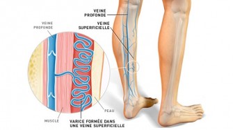 Le traitement des varices des membres inférieurs