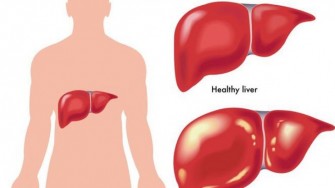 Transplantation hépatique à partir de donneur vivant pour carcinome hépatocellulaire : Au-delà des critères de milan ?