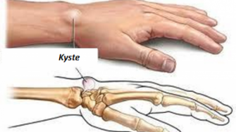 Kyste sébacé et kyste épidermique