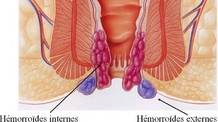 Les hémorroïdes 