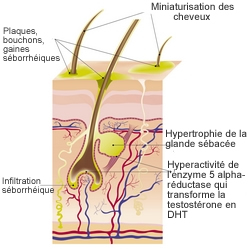 Schéma de la chute androgénique 