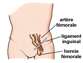 Hernie fémorale ou crurale