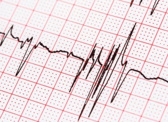 Fibrillation atriale