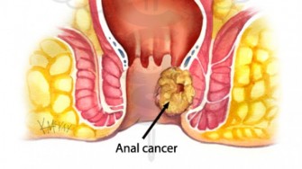 Cisplatine ne peut remplacer la mitomycine dans la prise en charge thérapeutique du cancer du canal anal