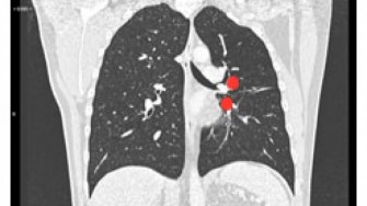 Y a-t-il une place pour les anti-angiogéniques dans les tumeurs carcinoïdes ?