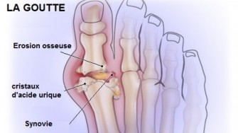 Larsenal thérapeutique contre la goutte va senrichir dun nouveau médicament.