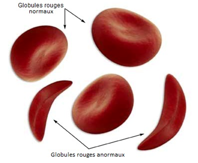 19 Juin : Journée mondiale de la drépanocytose