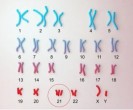 La trisomie 21 corrig&eacute;e en laboratoire