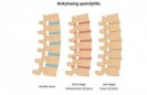 Spondylarthrite ankylosante
